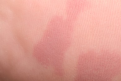 Photo of Macro view of dry human skin with red spots as background