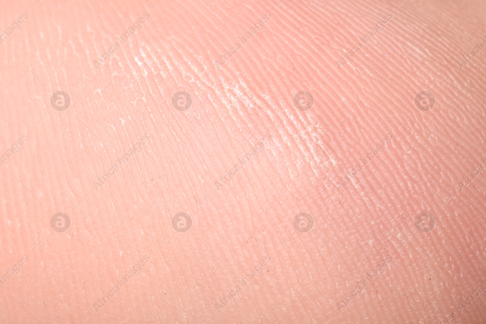 Macro view of dry human skin with wrinkles as background Photo of Macro view of dry human skin with wrinkles as background