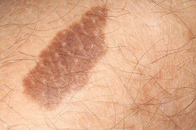 Photo of Macro view of human skin with birthmarks as background