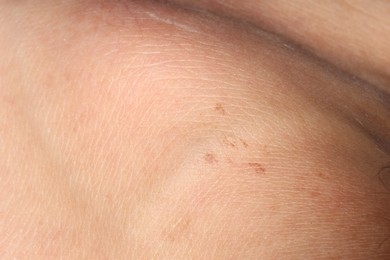 Photo of Macro view of human skin with birthmarks as background