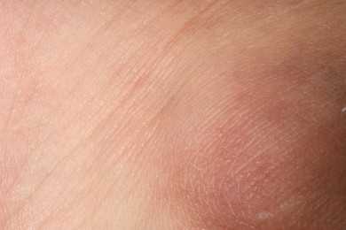 Photo of Macro view of human skin as background