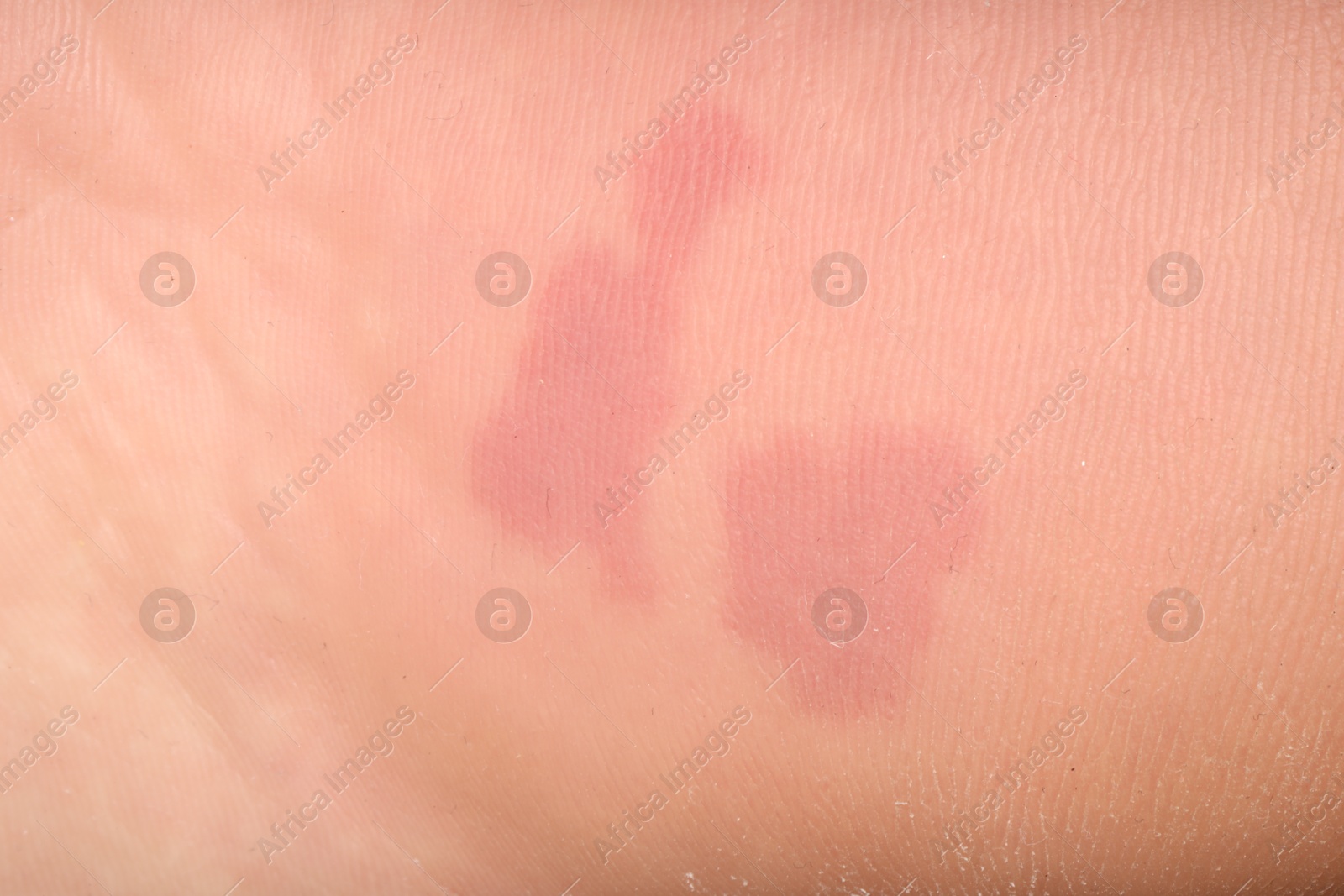 Macro view of dry human skin with red spots as background Photo of Macro view of dry human skin with red spots as background