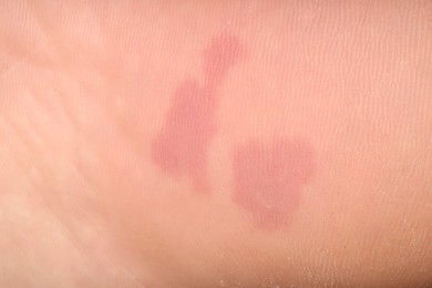 Photo of Macro view of dry human skin with red spots as background