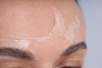 Photo of Woman with dry skin on her face against light background, closeup
