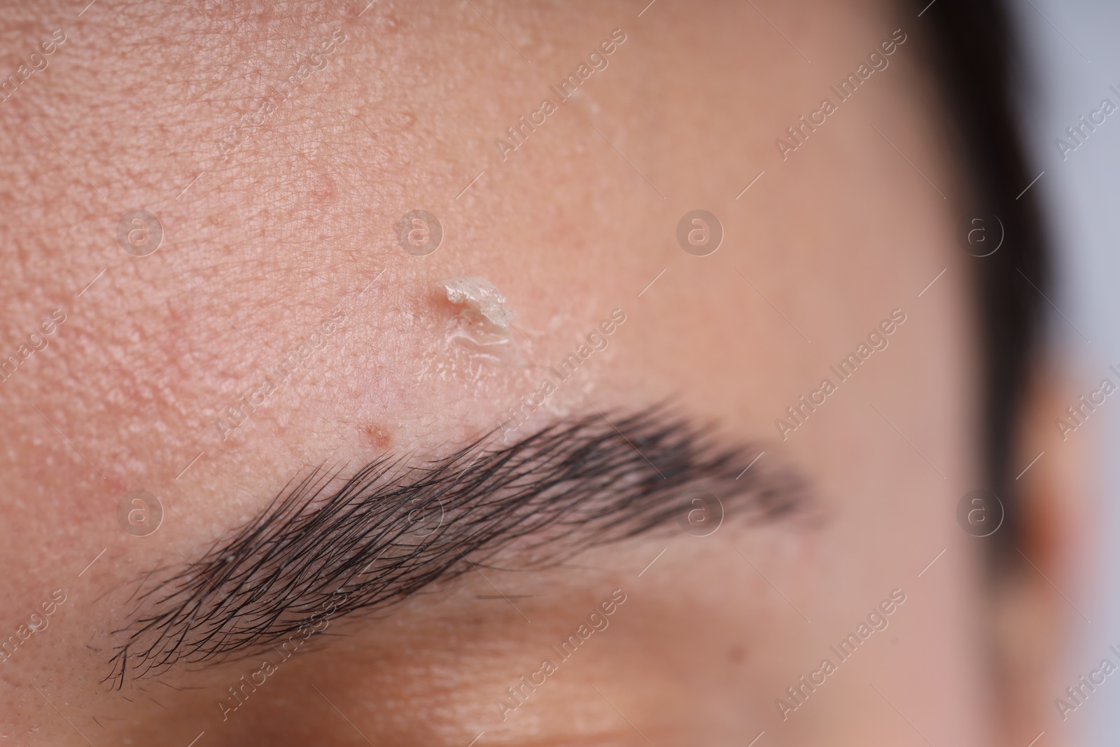 Photo of Woman with dry skin on her face, closeup
