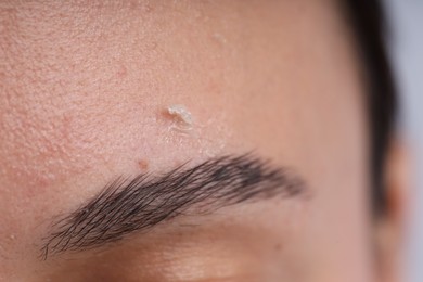 Photo of Woman with dry skin on her face, closeup