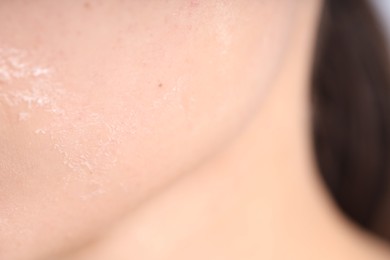 Photo of Woman with dry skin on her face, closeup