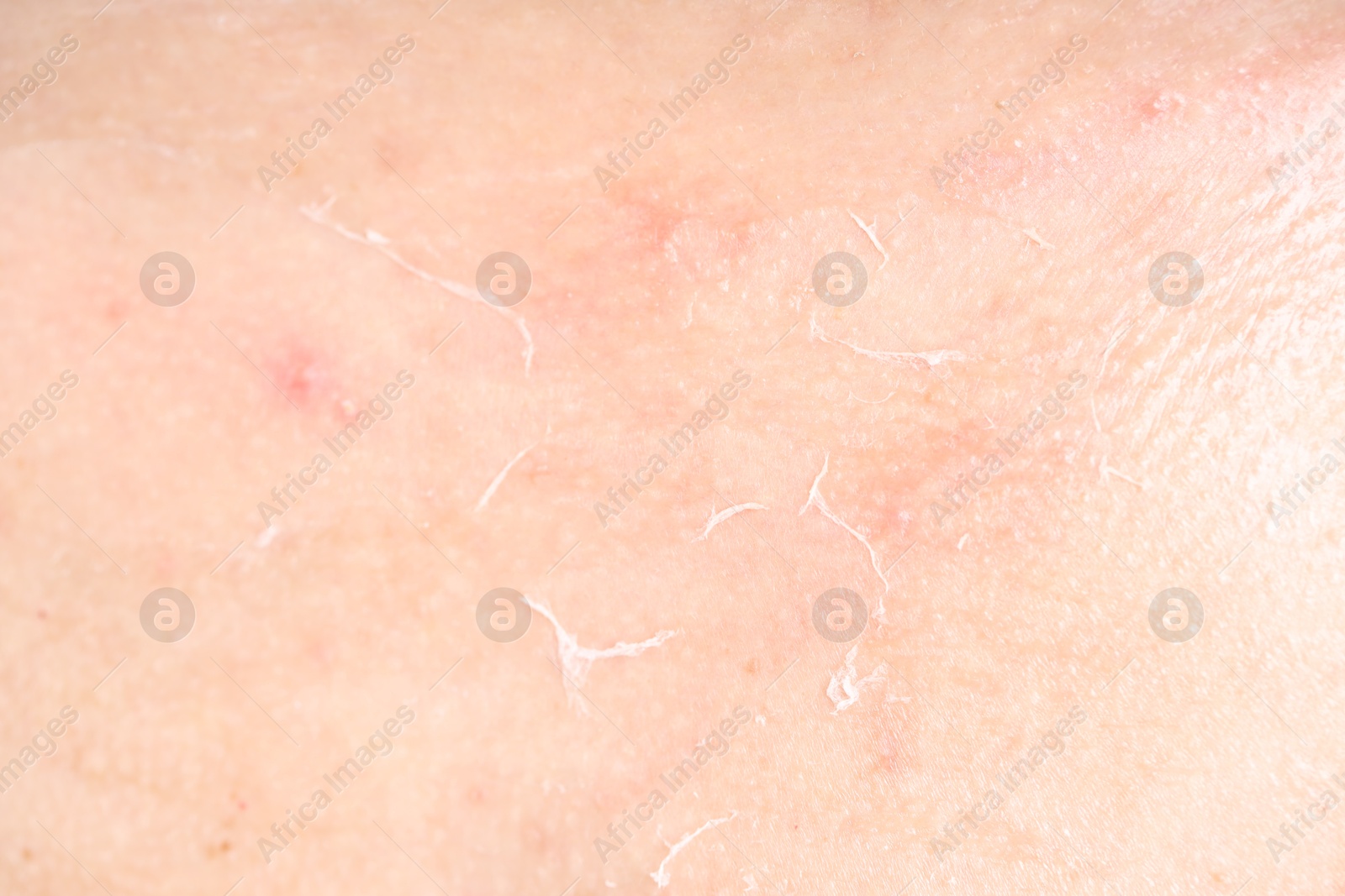 Photo of Closeup view of woman with dry skin