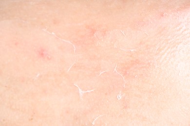 Photo of Closeup view of woman with dry skin