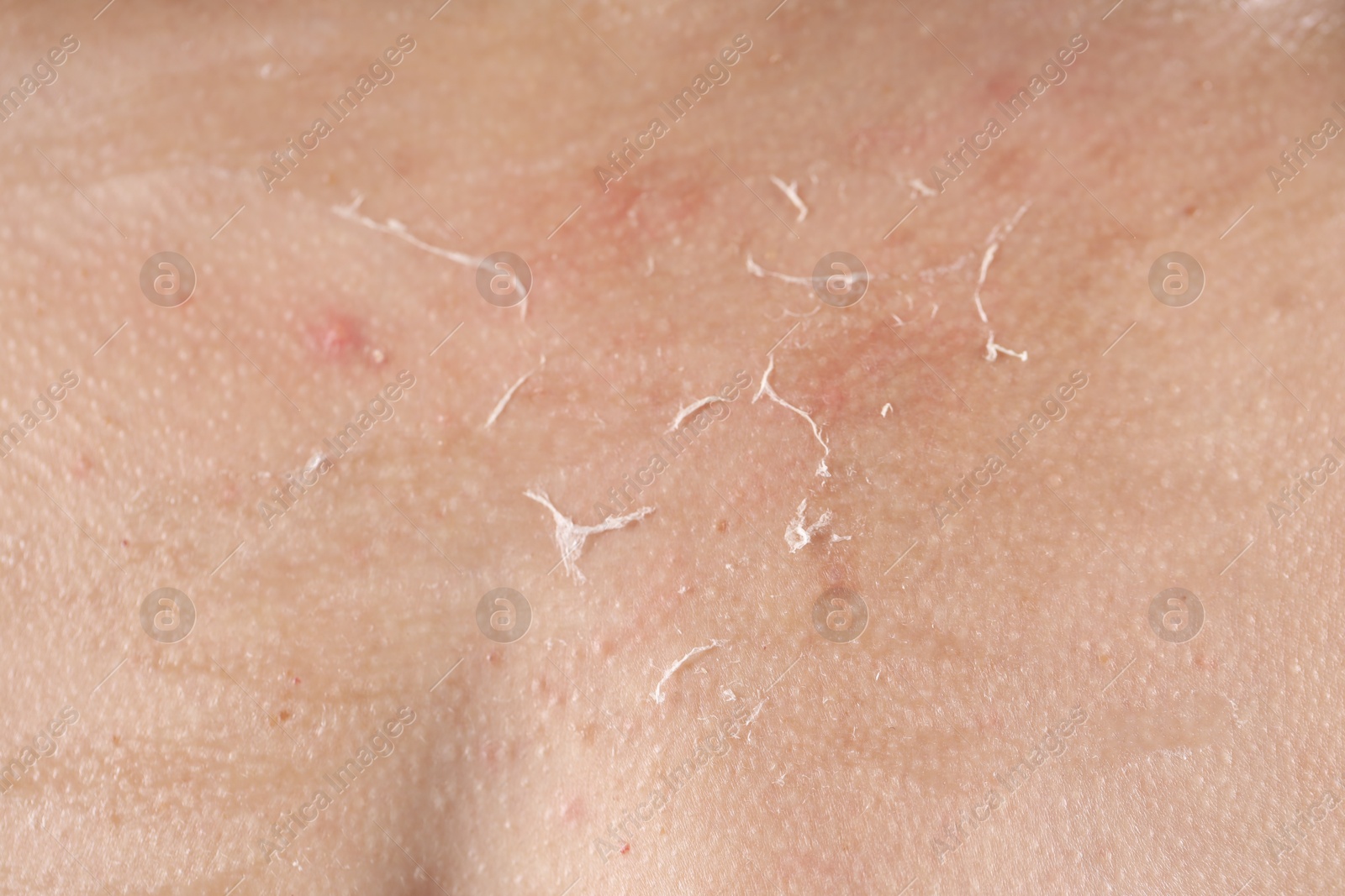 Photo of Closeup view of woman with dry skin