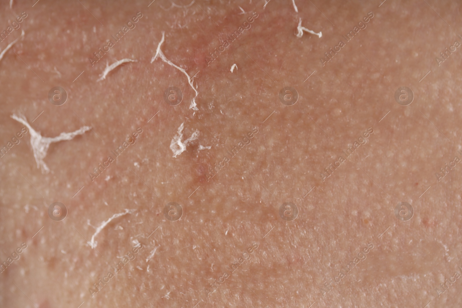 Photo of Closeup view of woman with dry skin