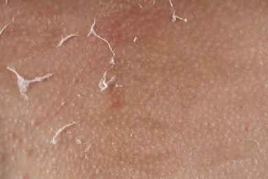 Photo of Closeup view of woman with dry skin