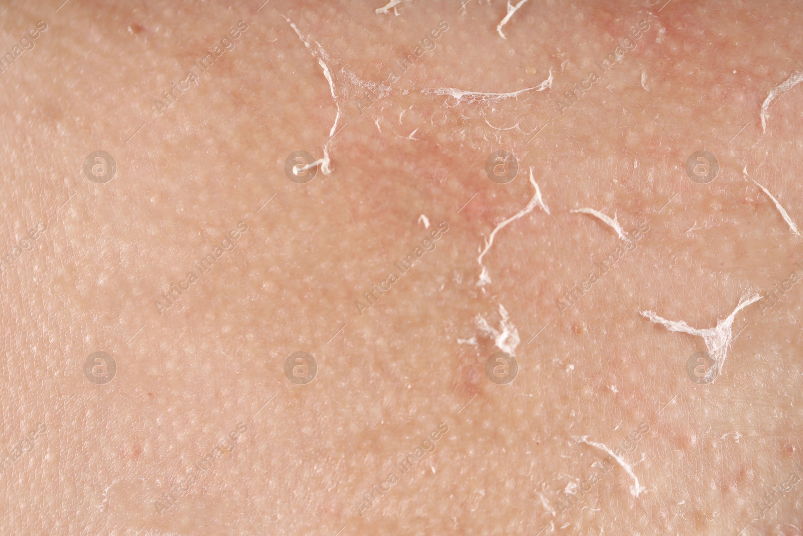 Photo of Closeup view of woman with dry skin
