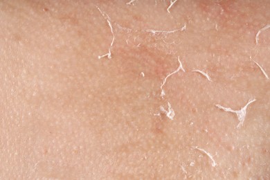 Photo of Closeup view of woman with dry skin
