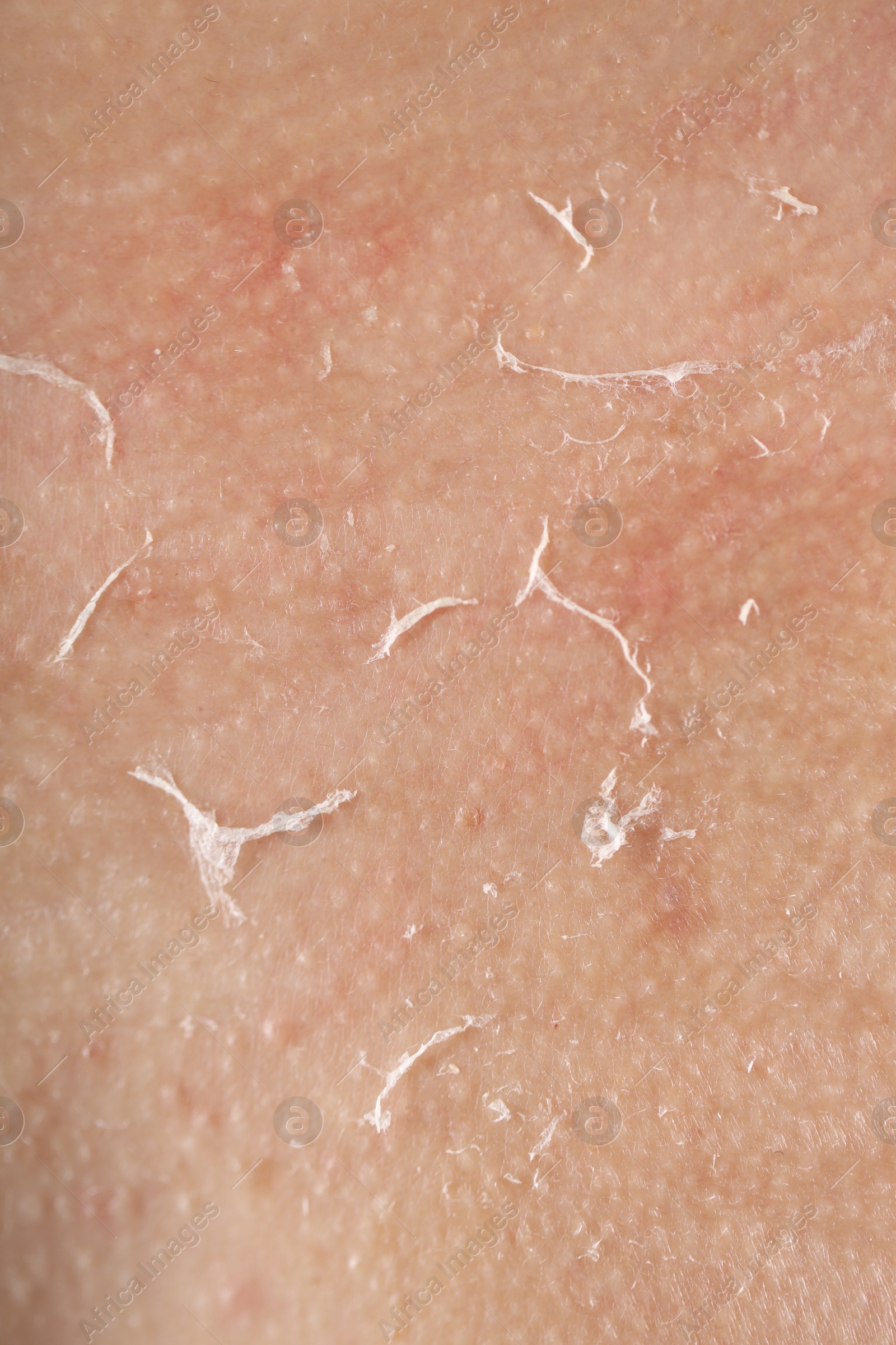 Photo of Closeup view of woman with dry skin