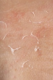 Photo of Closeup view of woman with dry skin