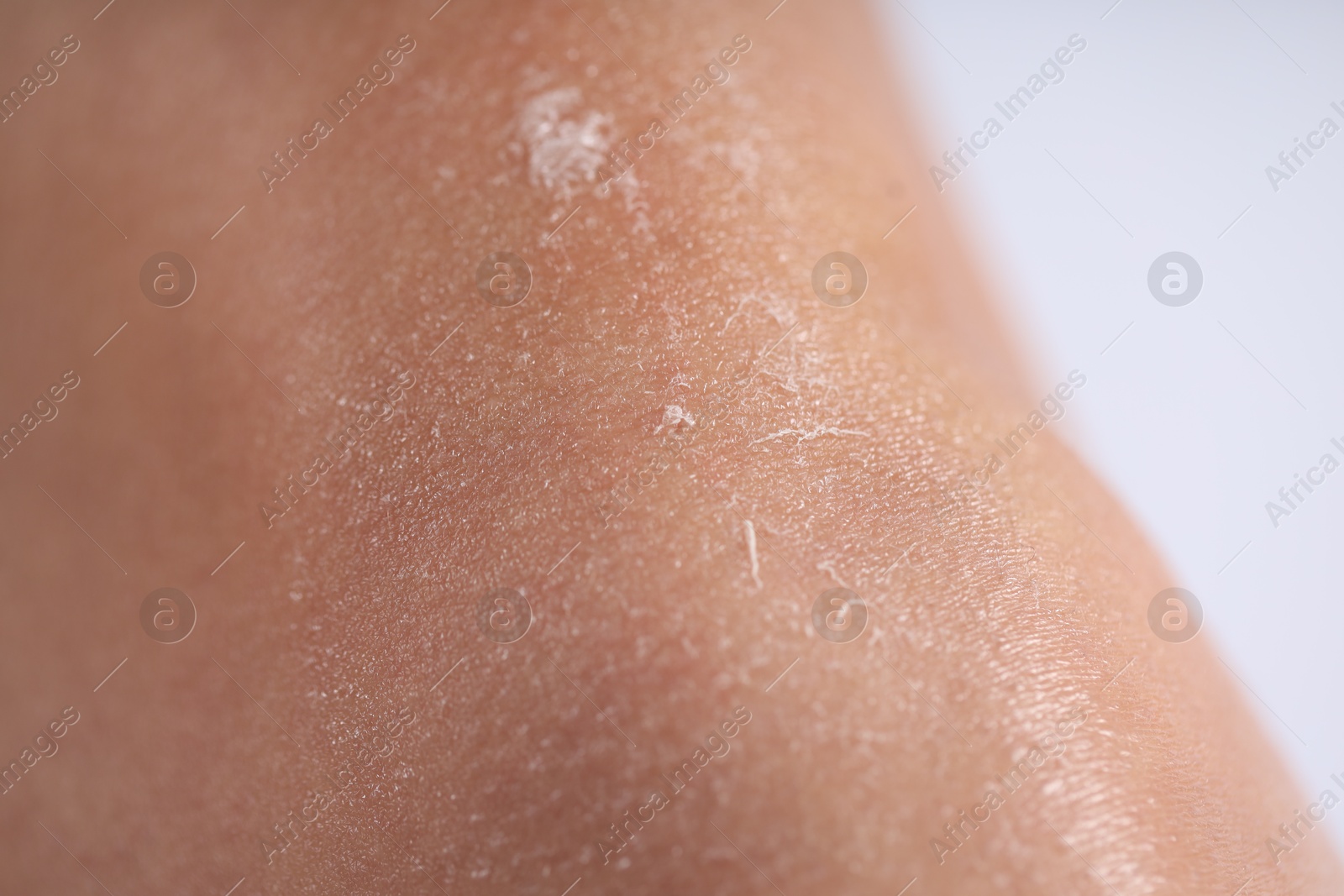 Photo of Woman with dry skin on her leg against light background, closeup