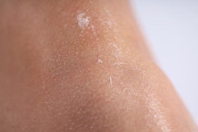 Photo of Woman with dry skin on her leg against light background, closeup