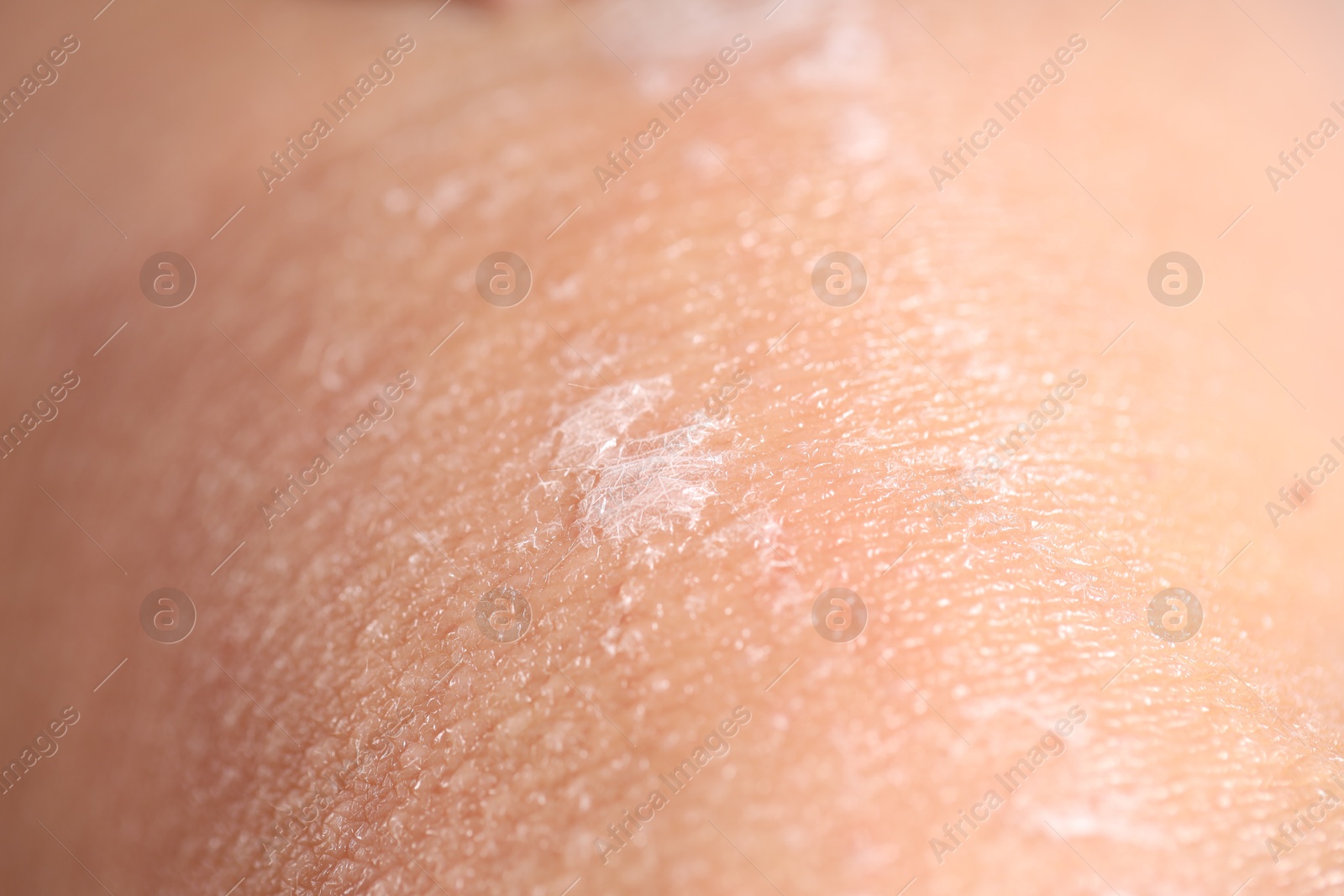 Photo of Closeup view of woman with dry skin