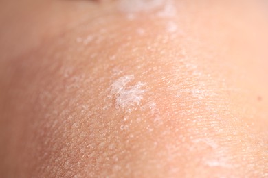 Photo of Closeup view of woman with dry skin