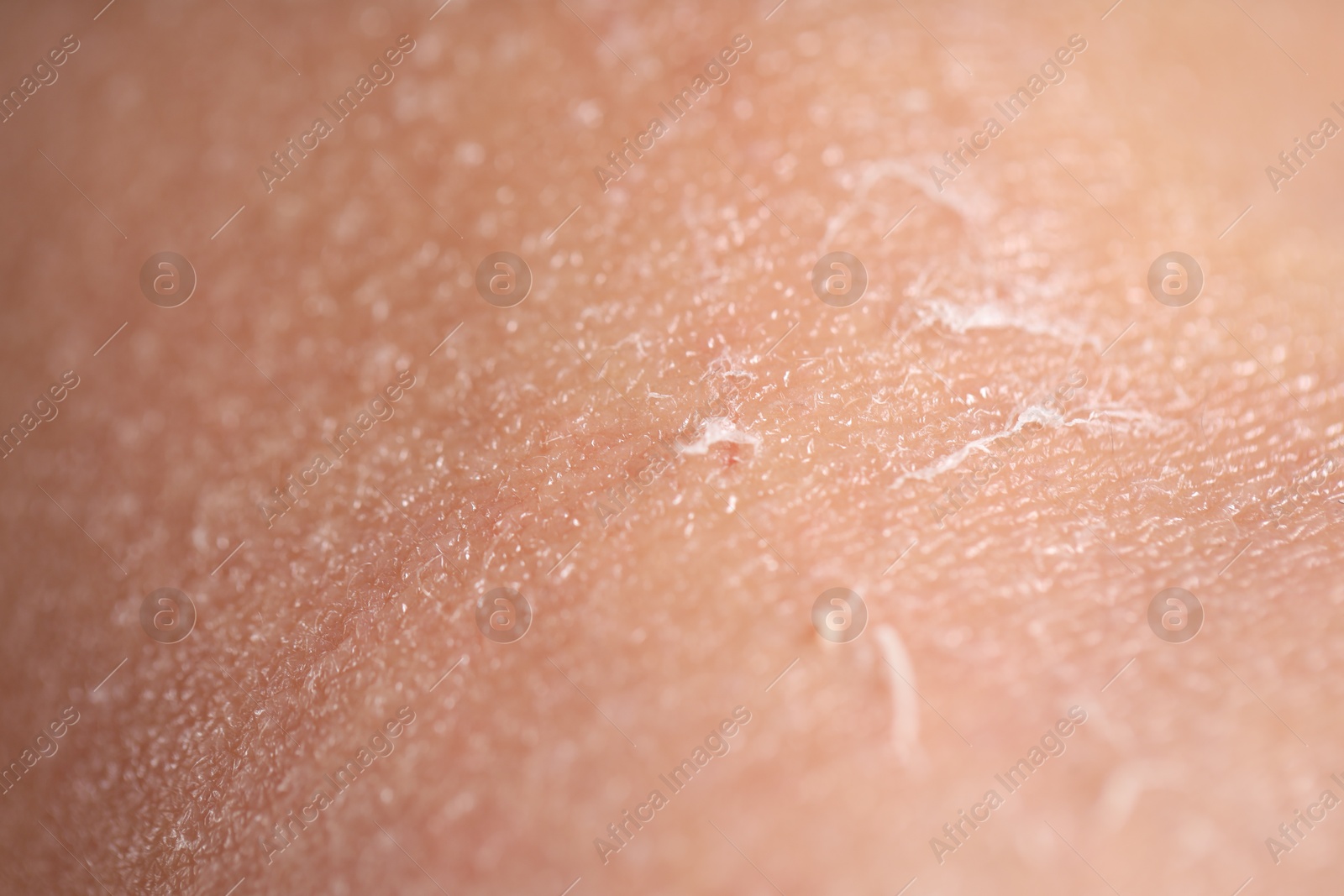 Photo of Closeup view of woman with dry skin