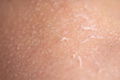 Photo of Closeup view of woman with dry skin