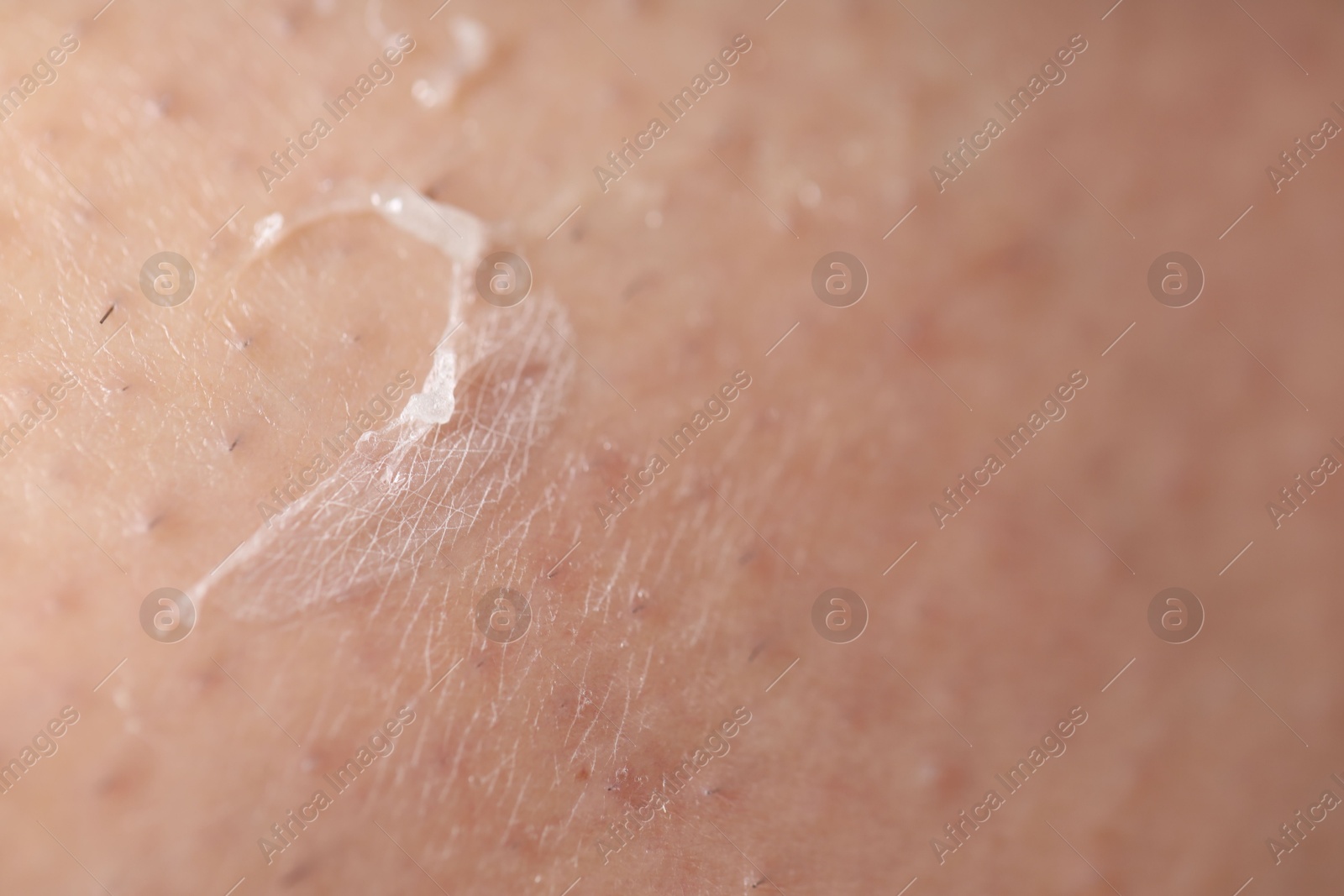 Photo of Closeup view of woman with dry skin