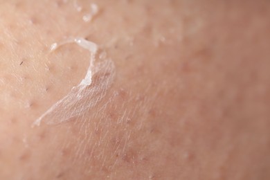 Photo of Closeup view of woman with dry skin
