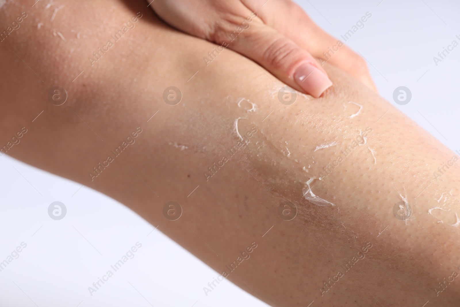 Photo of Woman with dry skin on her leg against light background, closeup