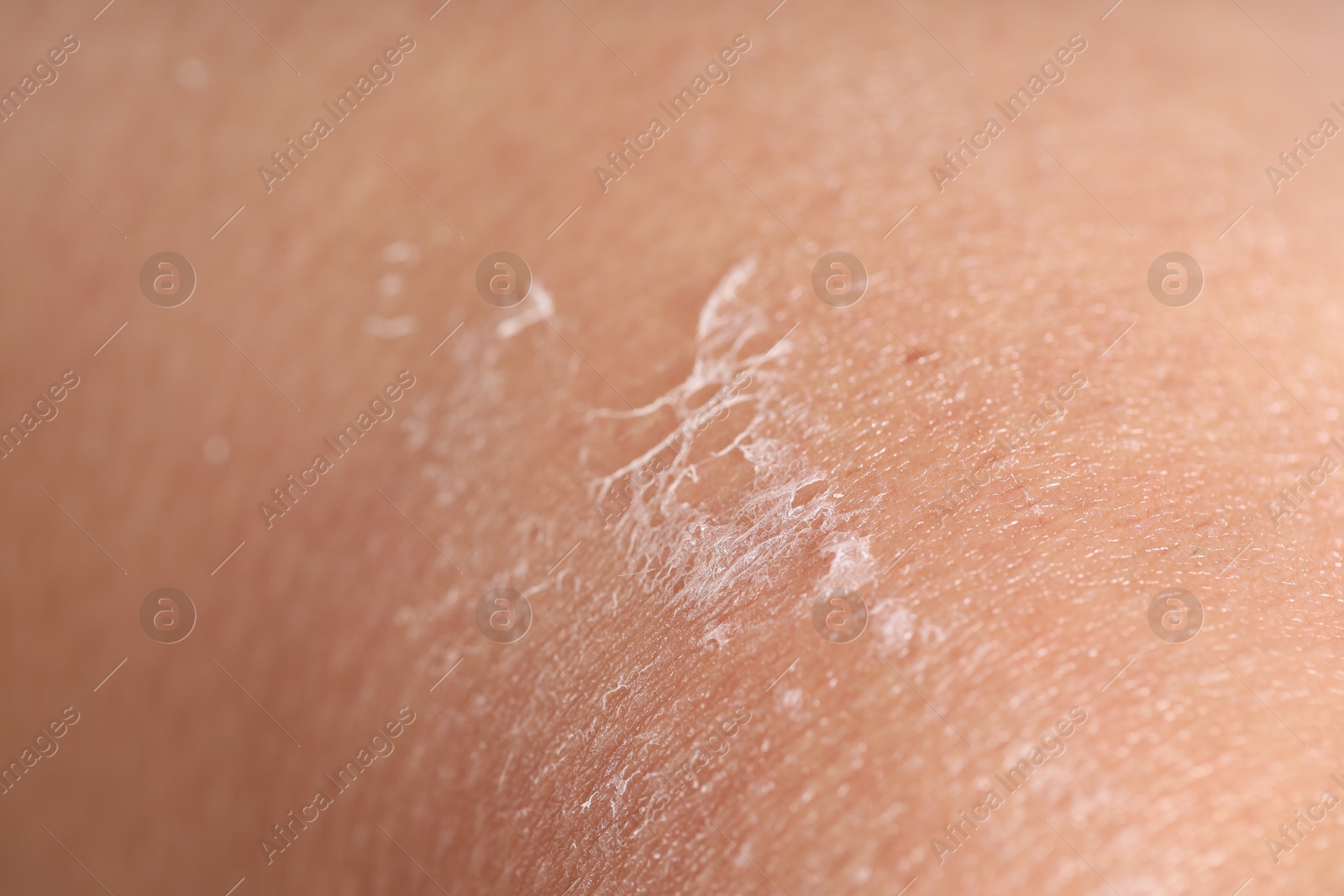 Photo of Closeup view of woman with dry skin