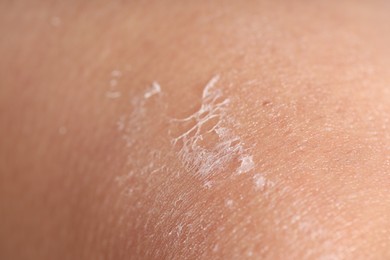 Photo of Closeup view of woman with dry skin