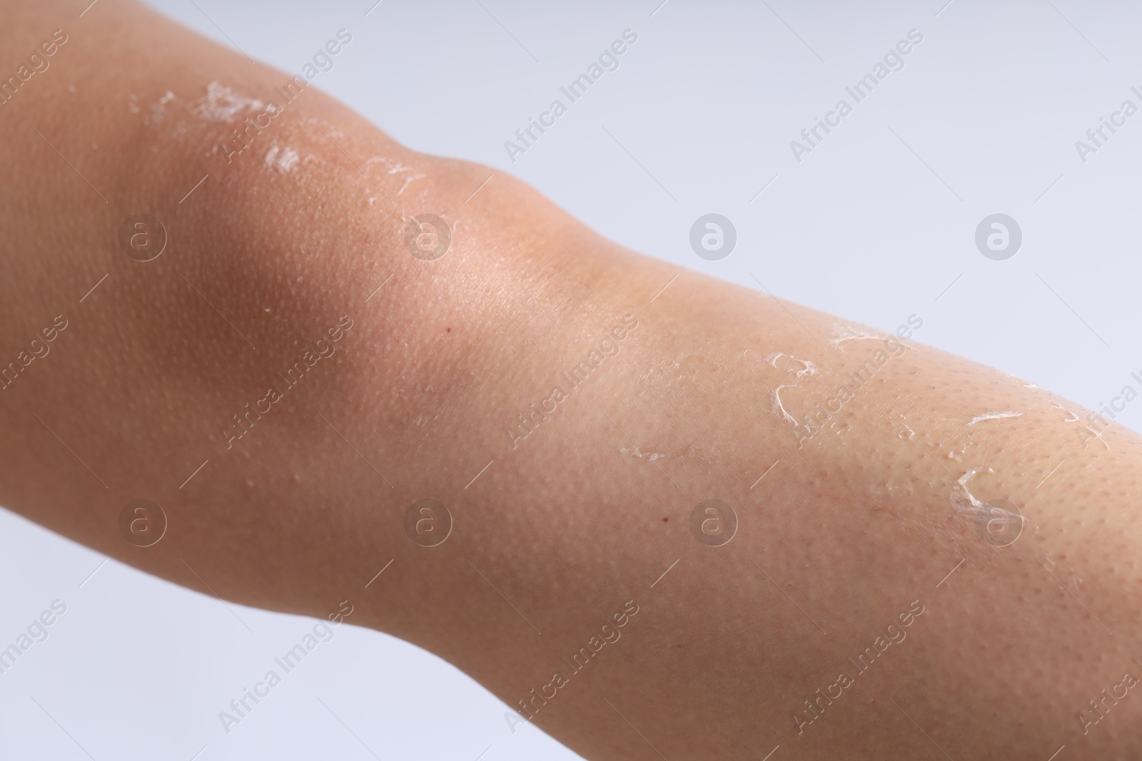 Photo of Woman with dry skin on her leg against light background, closeup