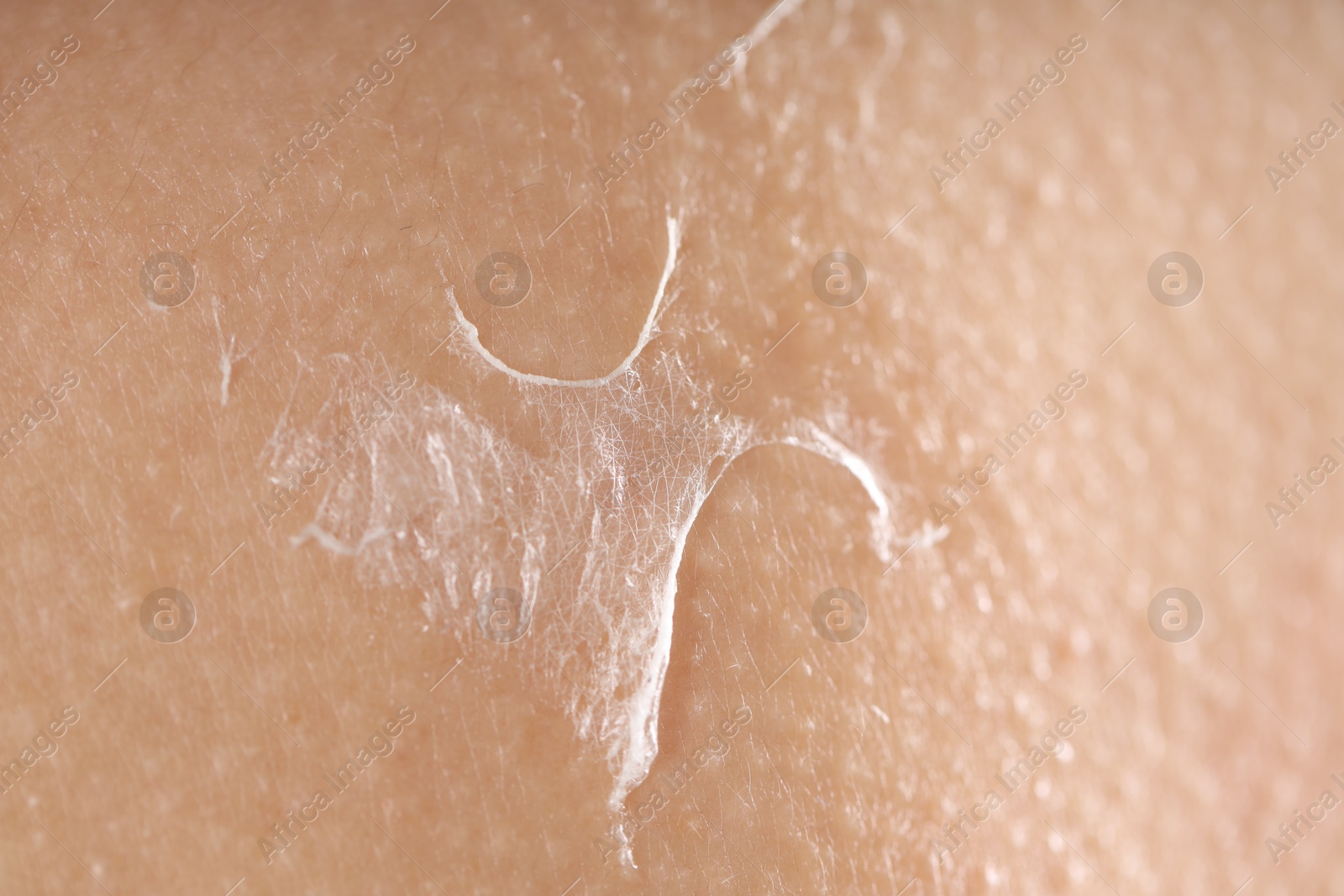 Photo of Closeup view of woman with dry skin