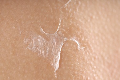 Photo of Closeup view of woman with dry skin