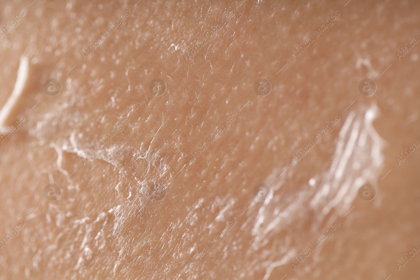 Photo of Closeup view of woman with dry skin