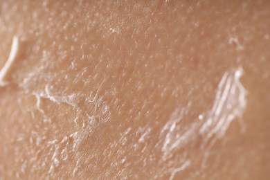 Photo of Closeup view of woman with dry skin