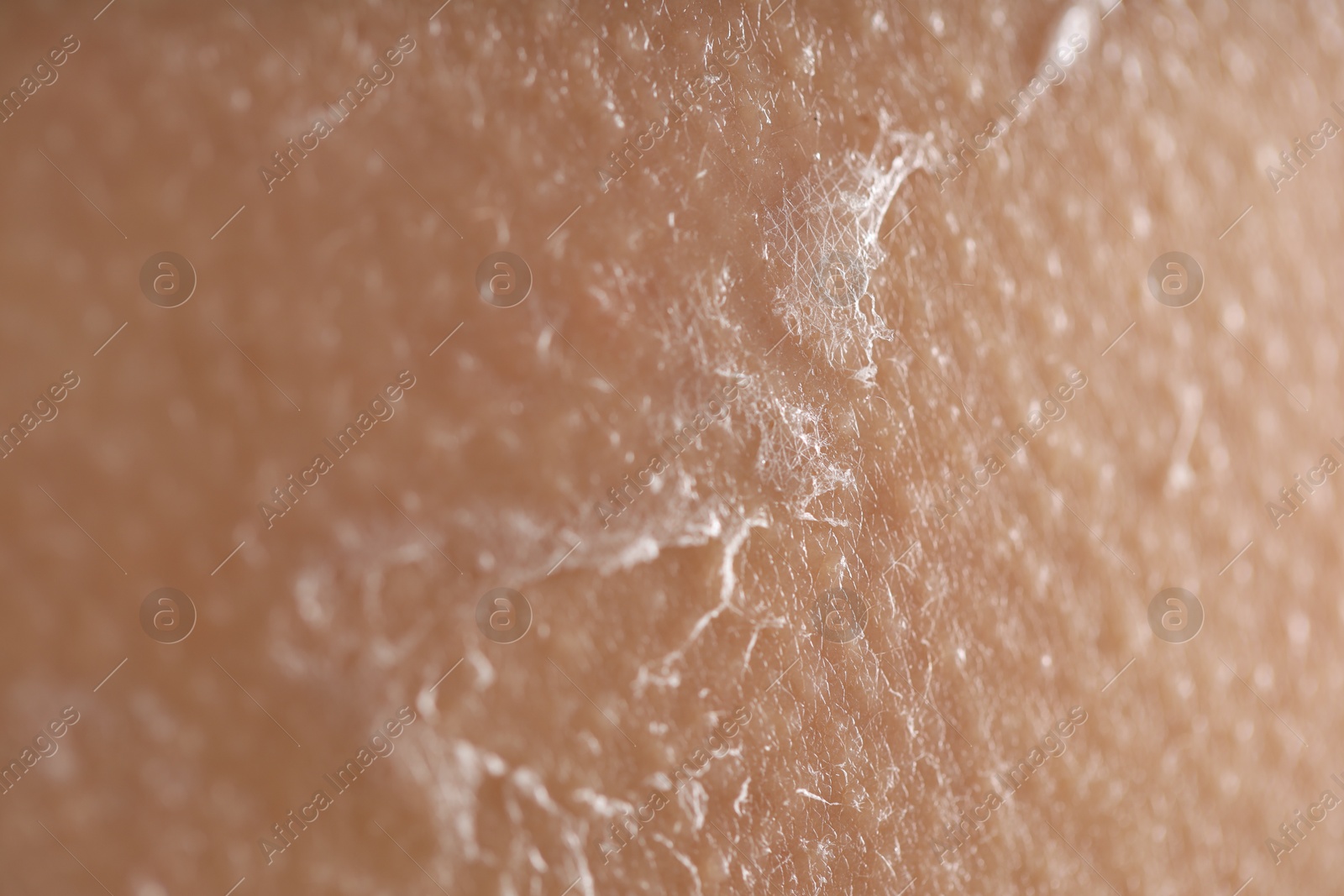 Photo of Closeup view of woman with dry skin