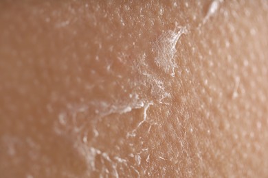 Photo of Closeup view of woman with dry skin