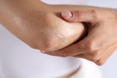 Photo of Woman with dry skin on her elbow against light background, closeup