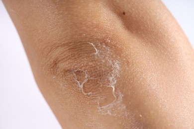 Photo of Woman with dry skin on her elbow against light background, closeup