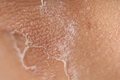 Photo of Woman with dry skin on her elbow, closeup