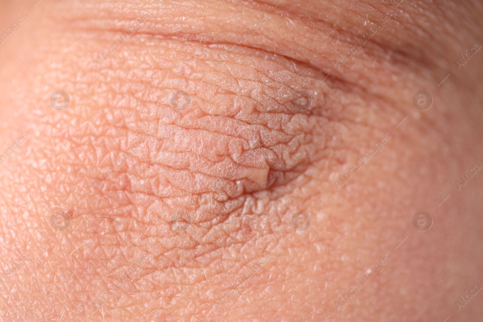Photo of Texture of dry skin as background, closeup