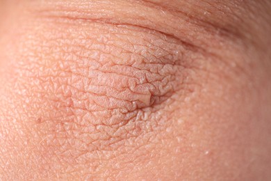 Photo of Texture of dry skin as background, closeup