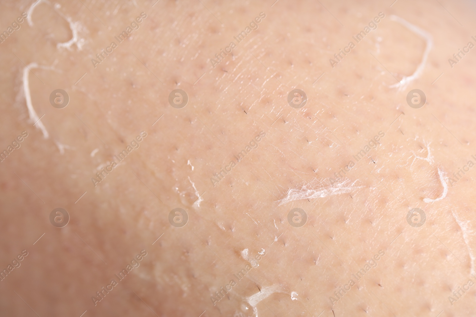 Photo of Closeup view of woman with dry skin