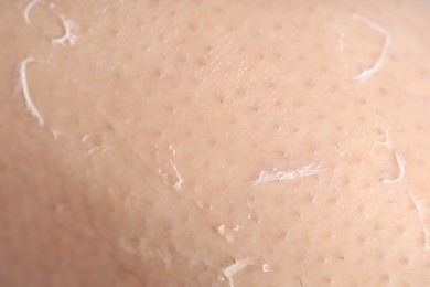 Photo of Closeup view of woman with dry skin