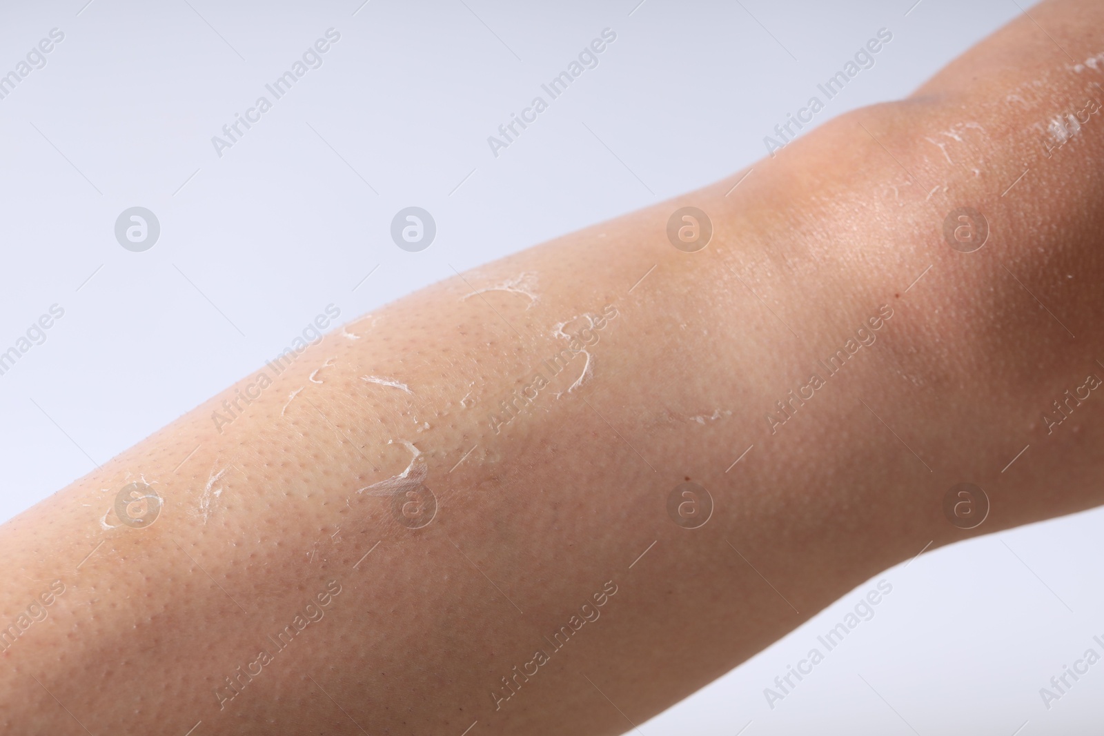 Photo of Woman with dry skin on her leg against light background, closeup
