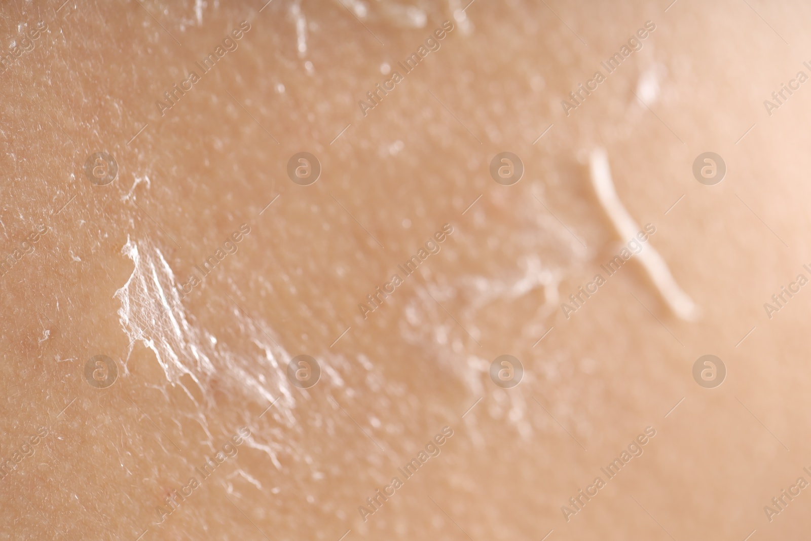 Photo of Closeup view of woman with dry skin