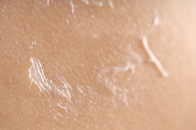 Photo of Closeup view of woman with dry skin