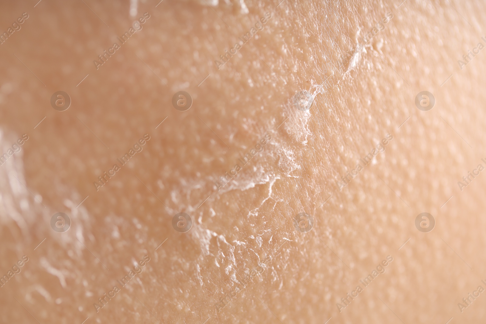 Photo of Closeup view of woman with dry skin