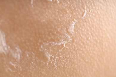 Photo of Closeup view of woman with dry skin